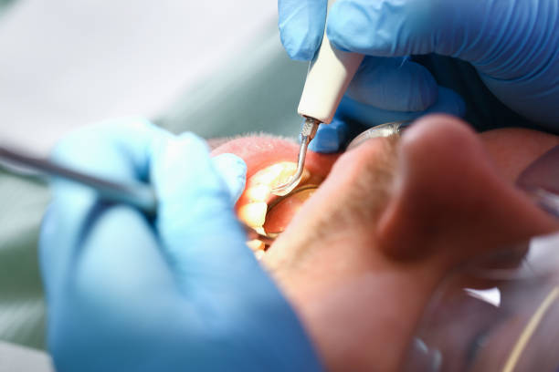 Best Emergency Wisdom Teeth Removal in Pittsboro, NC